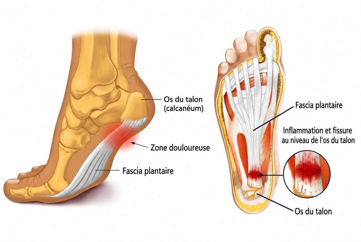 Le fascia plantaire soutient la voûte du pied. Surchargé, il se fissure — c'est l'inflammation au niveau de l'os du talon qui provoque la douleur.